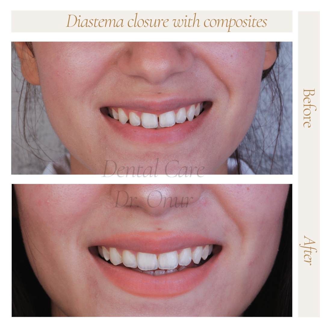 Kompozit restorasyonla diastema kapatma uygulamasının tedavi öncesi ve sonrası görünümü